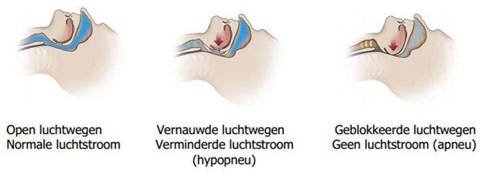 slaapprobleem-ben-scholten